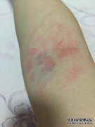 出汗，脖子后部，肘窝，膝盖窝