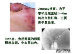 感染性心内膜炎